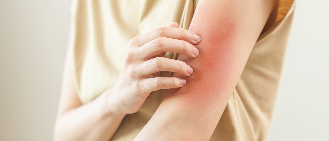 Τσιμπήματα